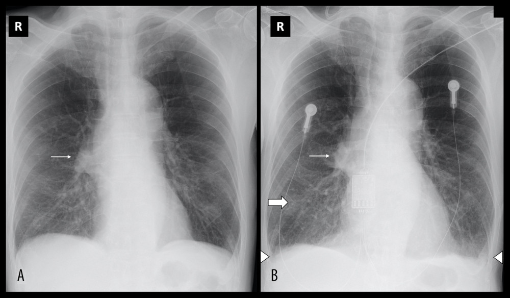 Serial chest radiographs of a 77-year-old man who presented with progressive cough and shortness of breath for 2 days. (A) Initial chest radiograph performed on admission showed a right perihilar opacity (thin arrow), in keeping with known chronic middle-lobe collapse of uncertain etiology. There was no ground-glass opacity, consolidation, or pleural effusion. (B) A follow-up radiograph performed 10 days later showed interval development of subtle increased reticular opacities in the right lower zone (broad arrow). There were bilateral small pleural effusions (arrowheads).