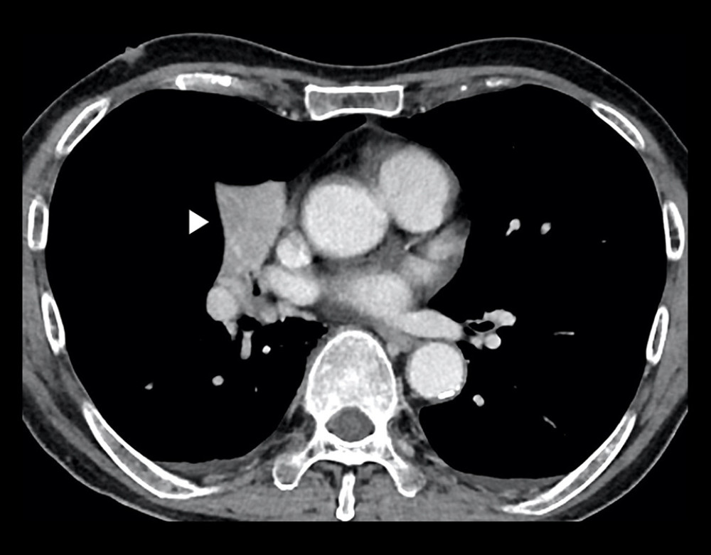 An axial contrast-enhanced CT image of a 77-year-old man who presented with progressive cough and shortness of breath for 2 days. A chronic middle-lobe collapse (arrowhead) is noted, which is probably a long-standing sequelae of prior infection. No associated mass, foreign body, or lymphadenopathy were detected.