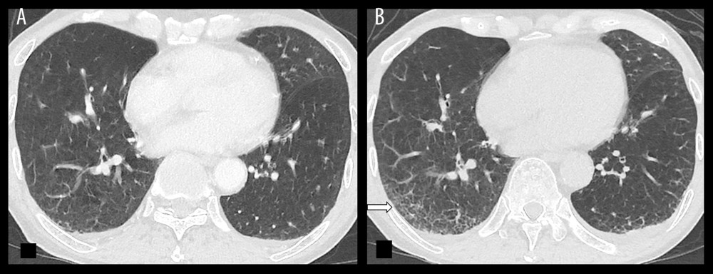 An axial chest CT images of a 77-year-old man who presented with progressive cough and shortness of breath for 2 days, placed side-by-side for comparison. The initial contrast-enhanced CT study (A) performed on day 6 of illness onset showed no evidence of ground-glass opacity or consolidation. A repeat plain CT study (B) obtained on day 14 of illness onset in view of worsening shortness of breath demonstrated new subpleural interstitial thickening at the posterior aspect of the right lower lobe (arrow). There were also small bilateral pleural effusions.