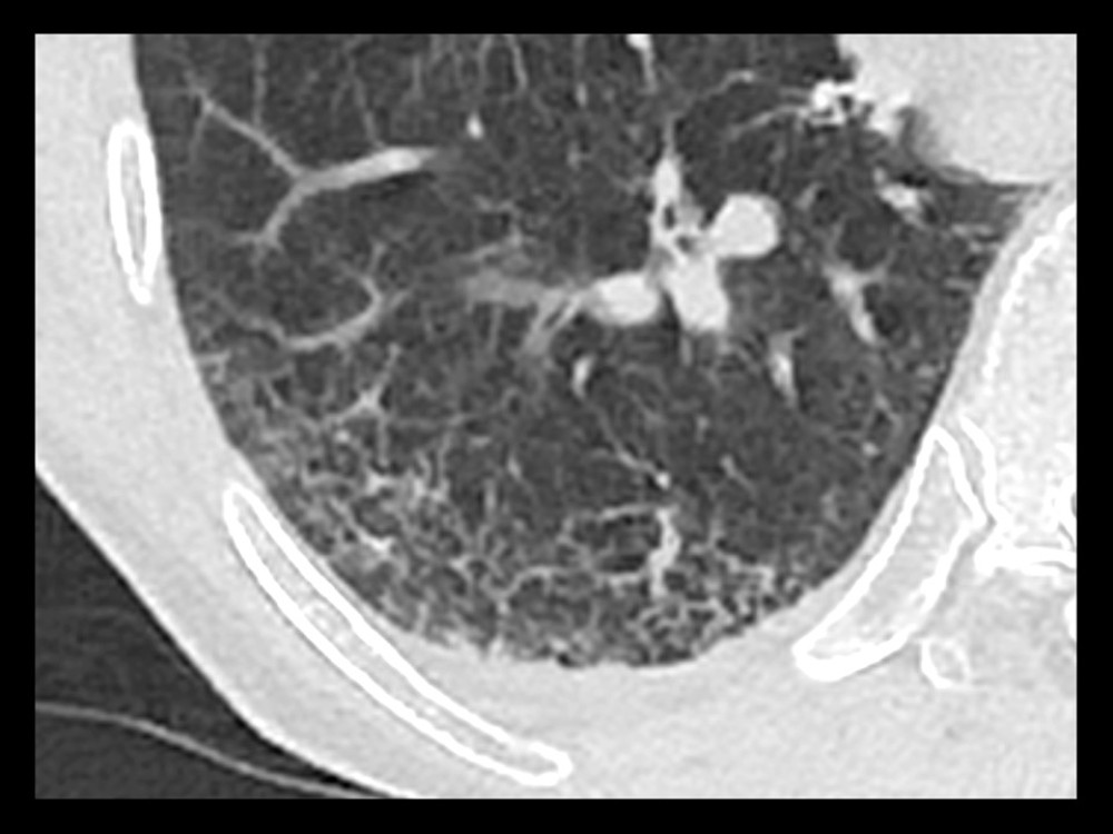 An axial plain CT image of a 77-year-old man who presented with progressive cough and shortness of breath for 2 days. This was performed on day 14 of illness onset. Subpleural smooth reticular opacities at the posterior aspect of the right lower lobe representing interstitial thickening were demonstrated. There were subtle adjacent ground-glass changes, which may be attributed to atelectasis or inflammation. No lung consolidation was detected, and no bronchiolectasis or peribronchial thickening was seen.