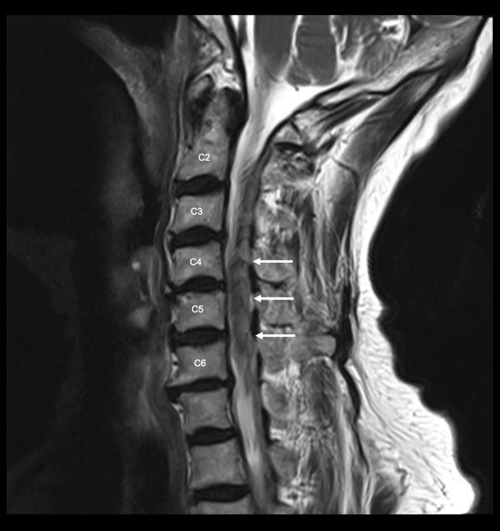Sagittal magnetic resonance image of the cervical spine (T2-weighted). The image shows an acute epidural hematoma (arrows) spanning the C2–C3 space to the C6 vertebra.