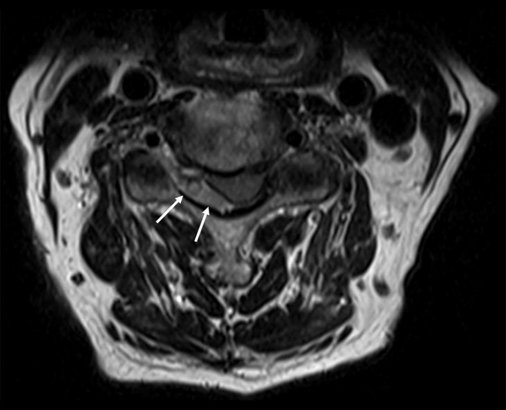 A transverse magnetic resonance image of the C4 vertebra (T2-weighted). The image shows the acute epidural hematoma (arrows). There is associated spinal canal stenosis with spinal cord deviation anteriorly and on the left side.