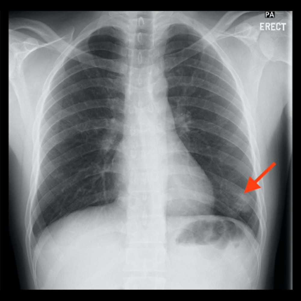 A chest radiograph revealed left lower-zone consolidation (arrow).