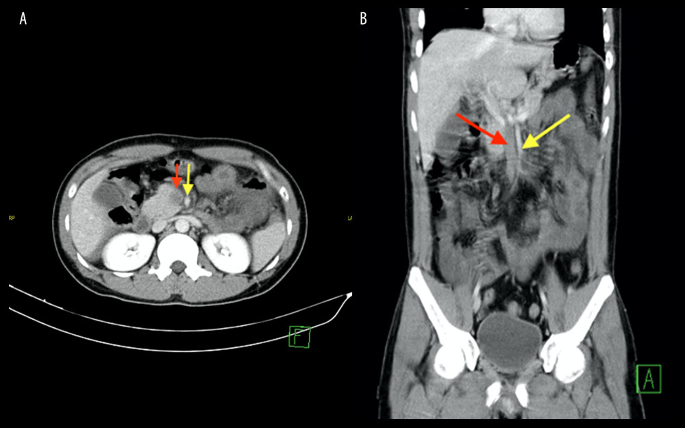The axial (A) and coronal (B) images of the abdomen reveal a large filling defect in the superior mesenteric vein (red arrow), in keeping with thrombosis. The superior mesenteric artery was noted to be patent (yellow arrow).