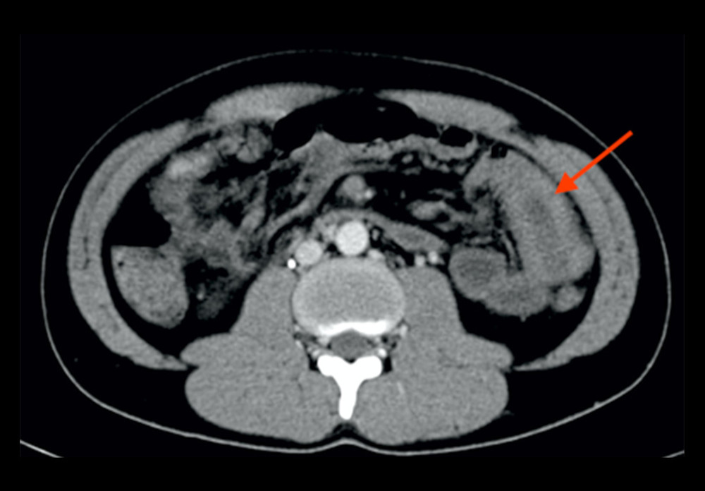 An axial CT scan showed diffuse mural thickening of the small-bowel loops (arrow), with normal contrast enhancement, in keeping with inflammatory changes.