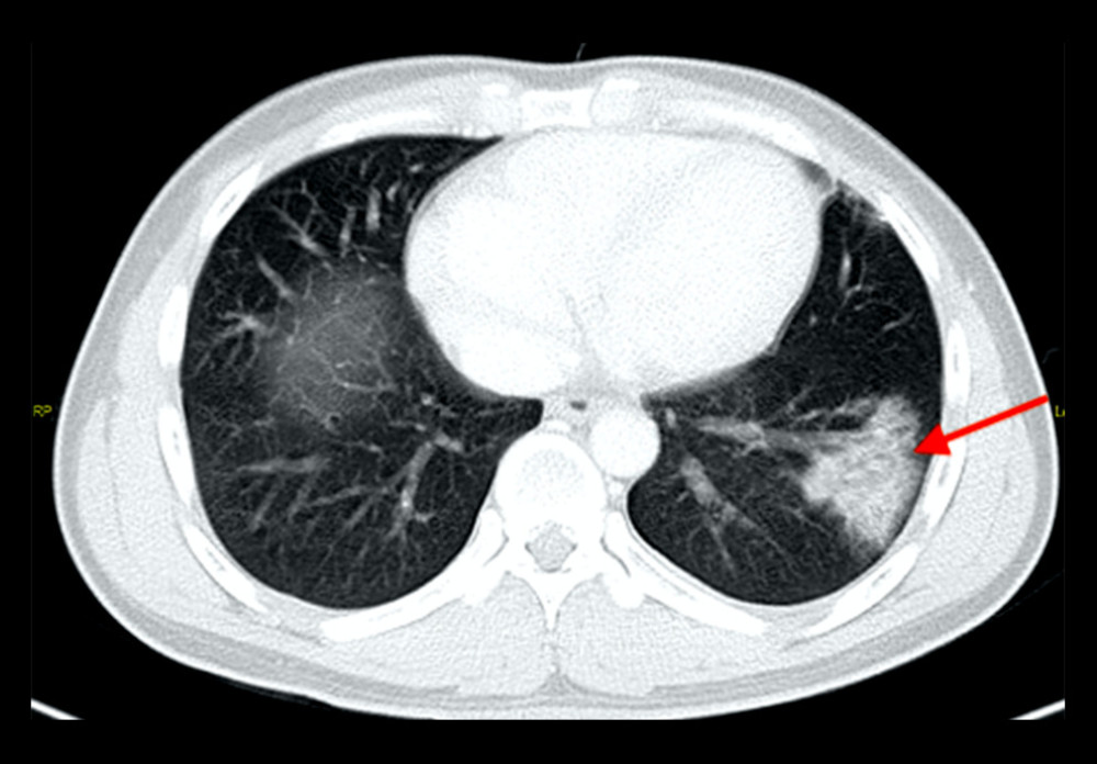 Axial CT scan of the lung base, confirming left lower-lobe consolidation (arrow), as seen on the chest radiograph.