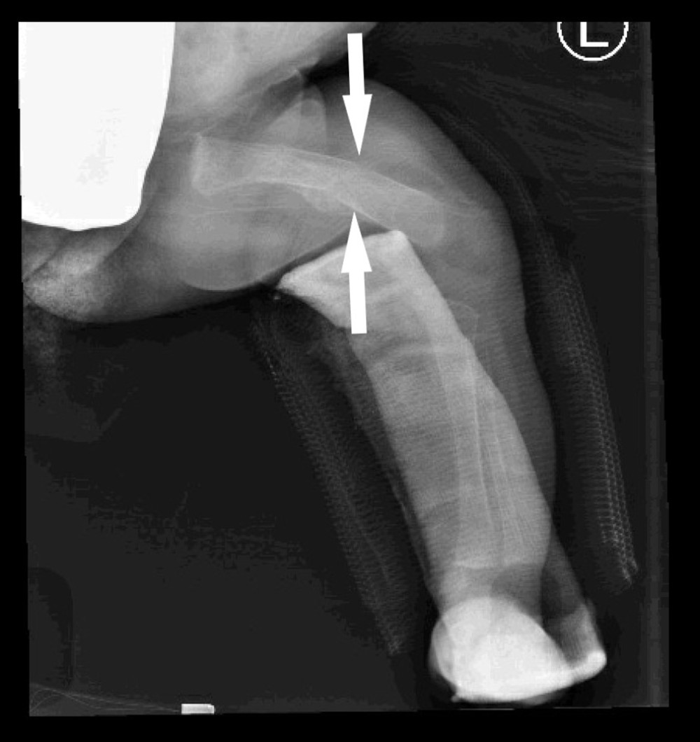 Follow-up radiograph of the fracture 10 days later.