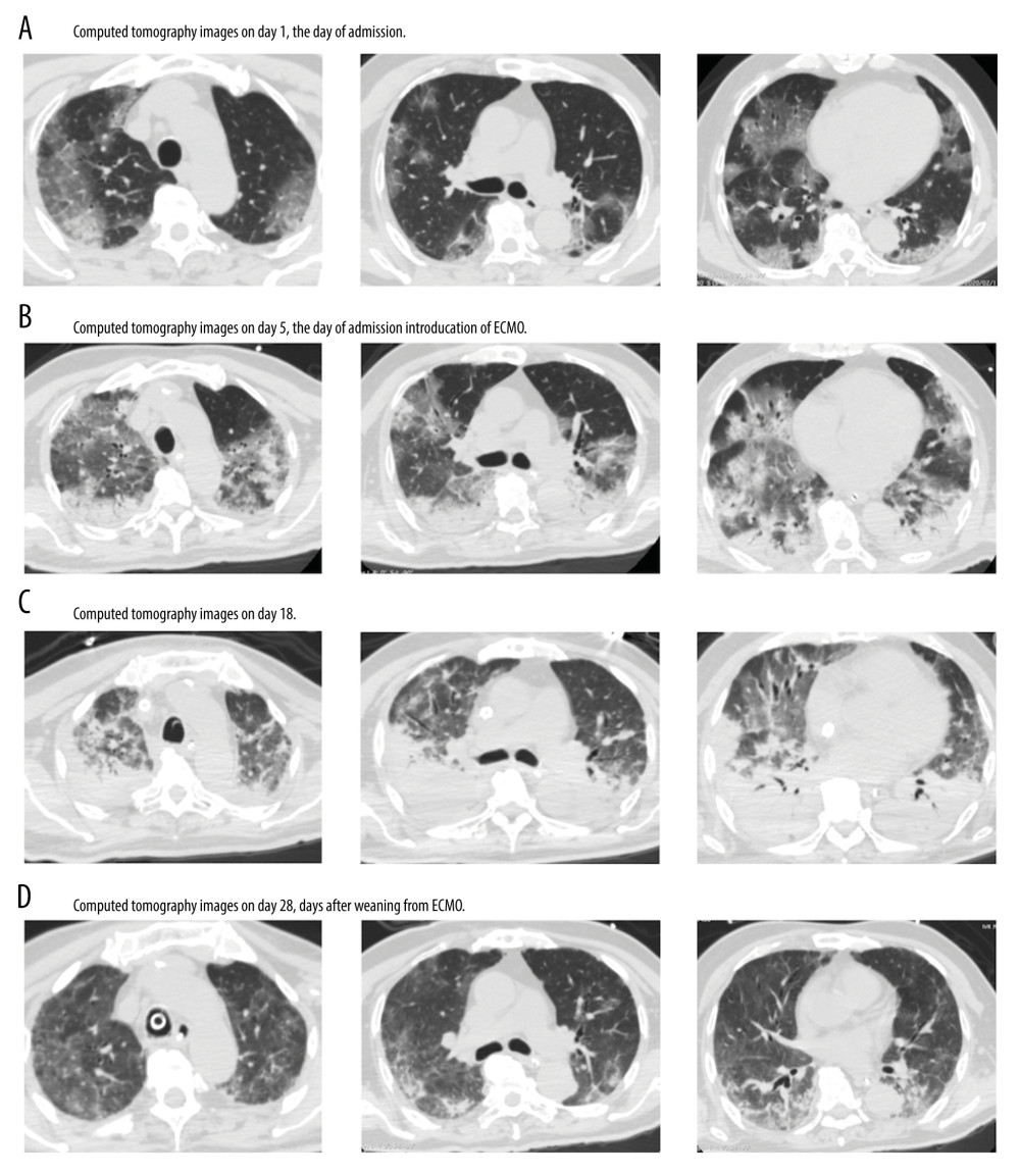 Chest computed tomographic images of a 72-year-old patient with severe acute respiratory distress syndrome due to COVID-19-associated pneumonia. (A) Images obtained on the day of admission exhibit multiple ground-glass opacities with a mosaic-like pattern in bilateral lungs. (B) Images taken on the fifth day, after intubation and introduction of veno-venous extracorporeal membrane oxygenation (VV ECMO), show diffuse large regions with a crazy-paving pattern in both lungs mixed with consolidation on the peripheral side. (C) Images taken on the 18th day show exacerbation of consolidation of both dorsal sides due to atelectasis and unchanged ground-glass opacities. (D) Images taken on the 28th day, 3 days after weaning off VV ECMO, reveal almost resolved consolidation in both lungs.