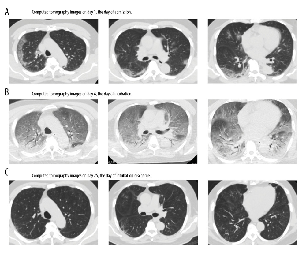 Chest computed tomographic images of a 70-year-old patient with moderate acute respiratory distress syndrome due to COVID-19-associated pneumonia. (A) Chest computed tomographic images obtained on the day of admission revealed bilateral subpleural ground-glass opacities. (B) Images taken on the fourth day after intubation show initial shrinking of ground-glass opacity shadows and their subsequent spreading. The shadows resemble those in diffuse alveolar damage. (C) Images taken on the 25th day before discharge reveal the absence of ground-glass opacities.