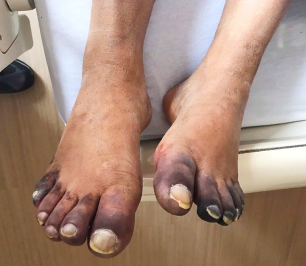Dermatologic manifestations on the dorsal aspect of the patient’s feet on day 11 of hospitalization in the setting of coronavirus disease 2019 caused by severe acute respiratory syndrome coronavirus 2.
