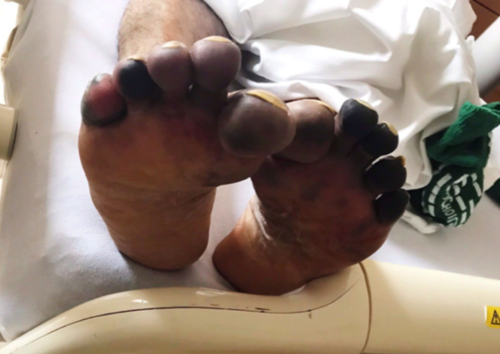Dermatologic manifestations on the plantar aspect of the patient’s feet on day 11 of hospitalization in the setting of coronavirus disease 2019 caused by severe acute respiratory syndrome coronavirus 2.