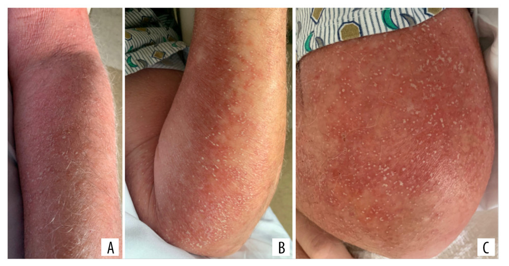 Clinical presentation. Acute generalized exanthematous pustulosis with numerous pinpoint pustules on edematous erythema of the left upper extremity (A), left posterior forearm (B), and left distal posterior triceps (C).