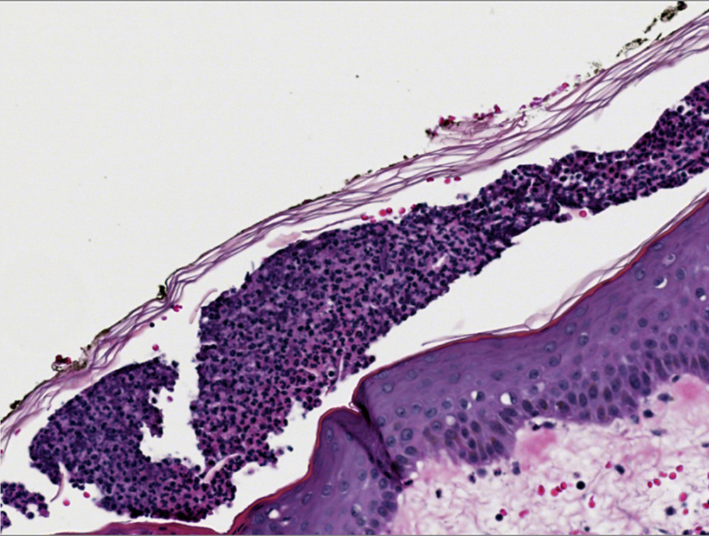 Histopathology. Acute generalized exanthematous pustulosis. The diagnostic histological features of acute generalized exanthematous pustulosis (AGEP) included intraepidermal neutrophils and exudate that formed pustules and papillary dermal oedema with neutrophils and eosinophils. Magnification, 40×. Stain, hematoxylin and eosin (H&E).