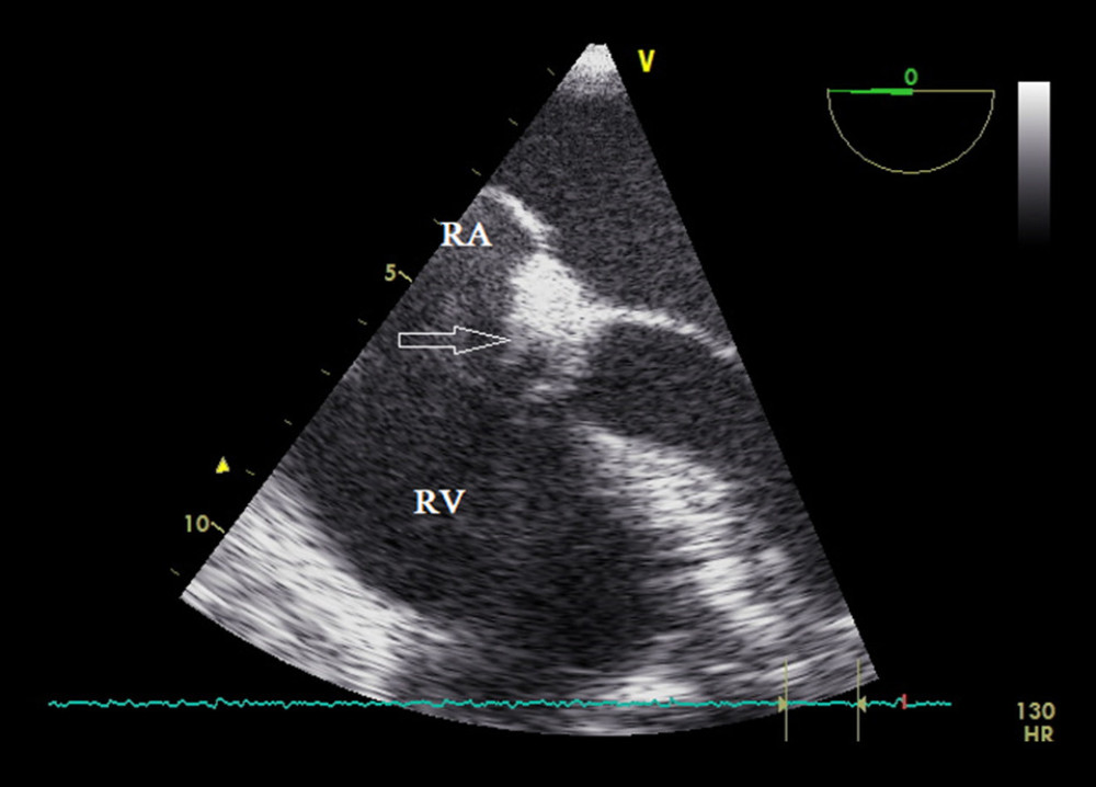 Transesophageal echocardiography, mid-esophageal 4-chamber view (intensive care unit day 15): thrombus in the right atrium (arrow). RA – right atrium; RV – right ventricle.