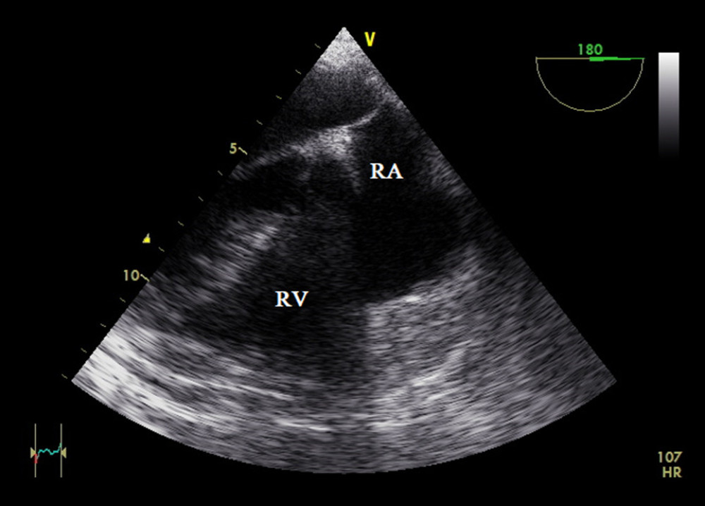 Transesophageal echocardiography, mid-esophageal 4-chamber view (intensive care unit day 36): no evidence of residual thrombus. RA – right atrium; RV – right ventricle.