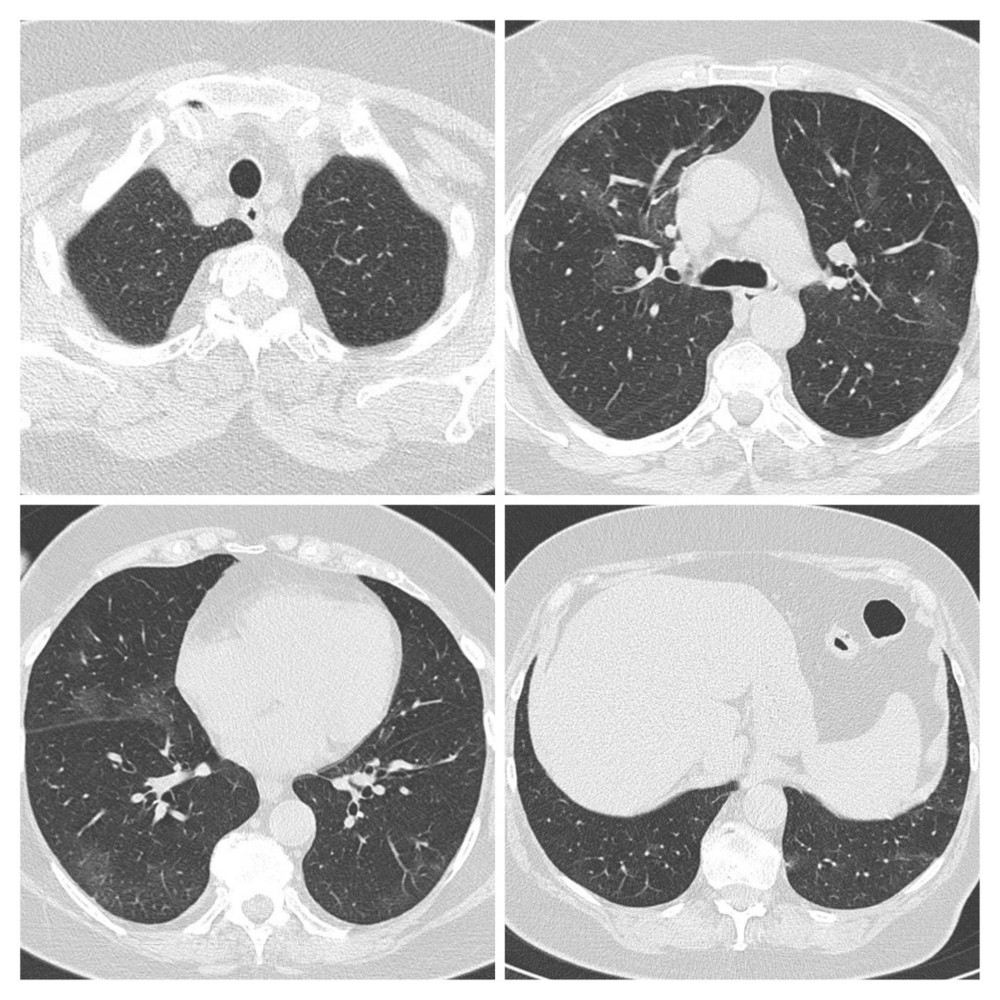 First CT scan of Patient 1 performed on March 27 after hospital admission showed multiple patchy ground-glass opacity and consolidation shadow in the bilateral lung view, which was suggestive for bilateral interstitial pneumonia.
