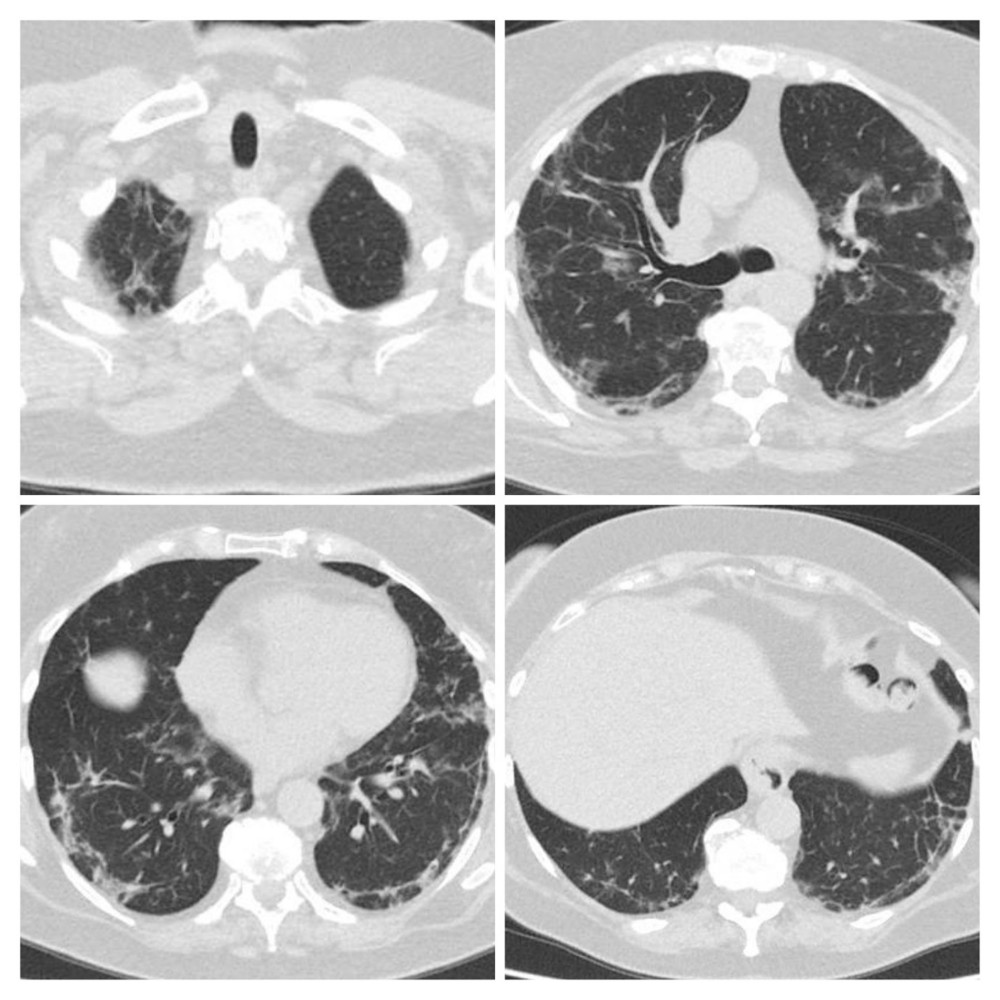 Second CT scan of Patient 1 performed on April 22 showed disease progression: increasing range of ground-glass density patches and consolidation, with scant fibrous interstitial stripes.