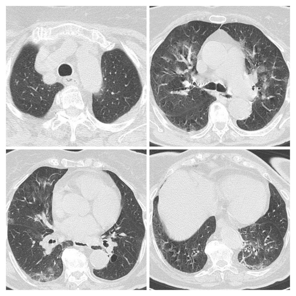 First CT scan of Patient 2 performed on March 25 showed multiple patchy ground-glass opacity and consolidation shadow in the bilateral lung view, mainly to the left, highly suggestive for bilateral interstitial pneumonia.