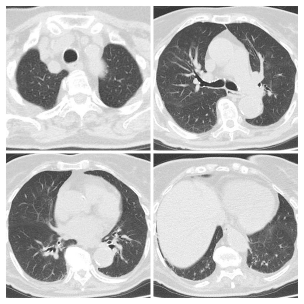 Second CT scan of Patient 2 performed on April 30 showed decreasing range of ground-glass density patches and consolidation but scant fibrous interstitial stripes, mainly in the basal lung segment.