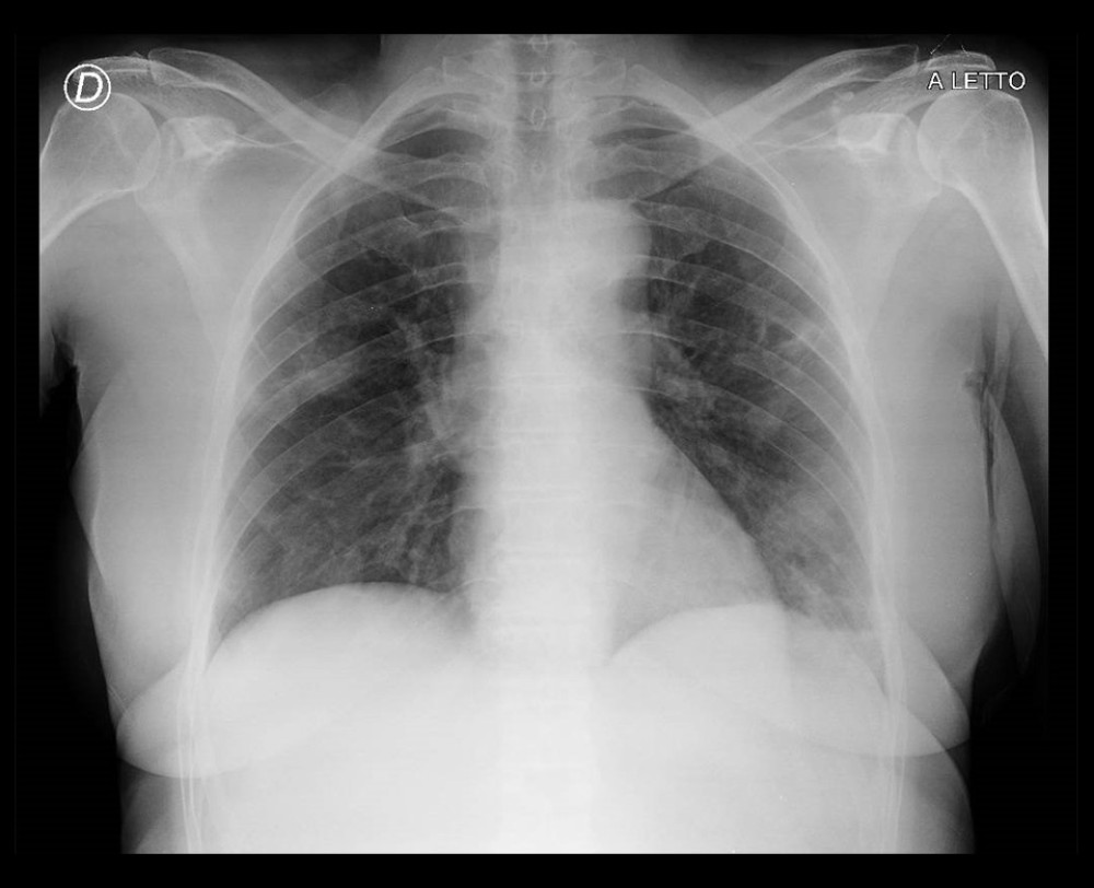 Chest radiograph of Patient 3 at presentation, 2020 (illness day 11).