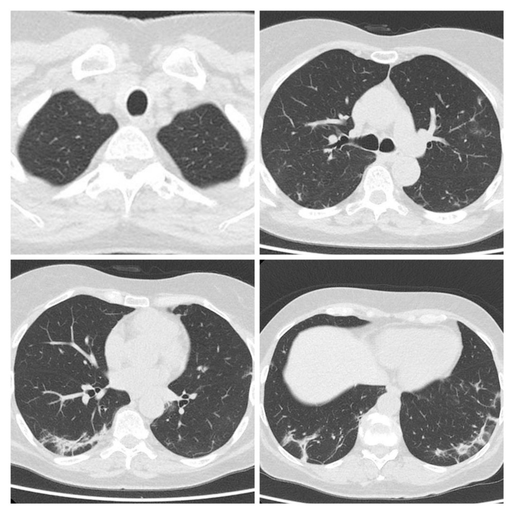 Follow-up CT scan of Patient 3: Consolidation shadow in bilateral lung view, interlobular septal thickening, and diffuse fibrous interstitial stripes are evident. Mediastinal lymphadenopathy can also be seen.