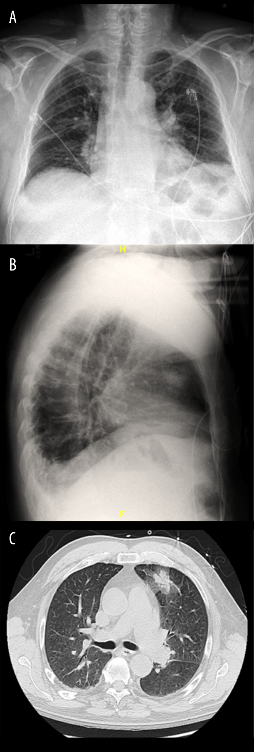 (A) Posteroanterior view of chest X-ray showing left upper-lobe consolidation obscuring the left mediastinal border. (B) Lateral view of chest X-ray showing left upper-lobe consolidation. (C) CT scan of chest showing left upper-lung consolidation with surrounding ground-glass and air bronchogram.