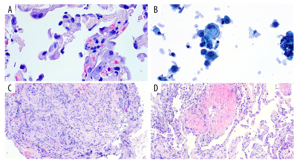 (A) Transbronchial lung biopsies from left upper lung showing pulmonary foamy macrophages and desquamated pneumocytes. (B) Thin prep from bronchoalveolar lavage with foamy macrophage. (C) Transbronchial lung biopsies from left upper lung showing organizing pneumonia. (D) Transbronchial biopsies from left upper lung show0ing acute fibrinous change.