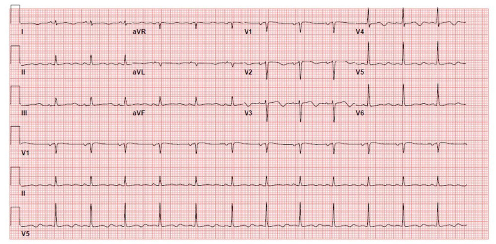 A 12-lead ECG showing the QT interval prolongation up to 600 msec on the second day of hospital admission.