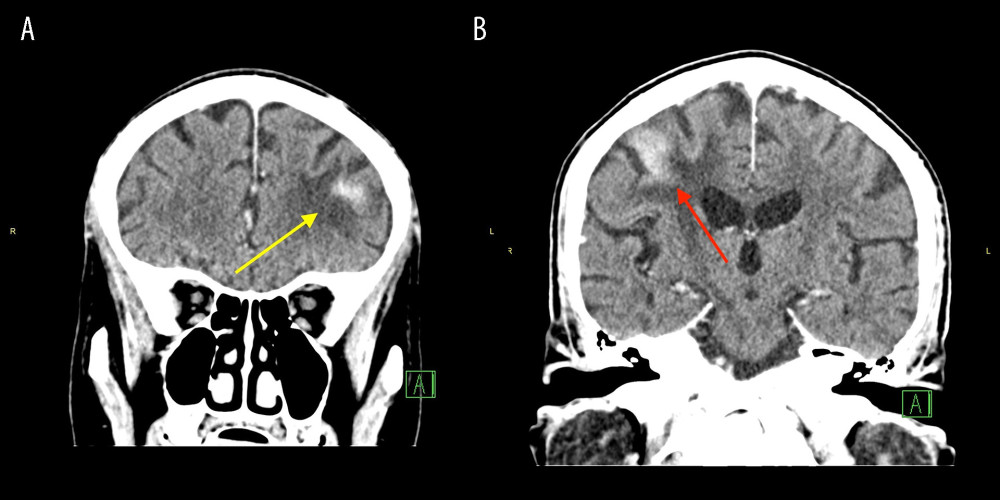 Coronal views of CT head showing hyperdense lesions in the left frontal lobe (A) (yellow arrow) and right frontal lobe (B) (red arrow) with surrounding areas of hypodensity.