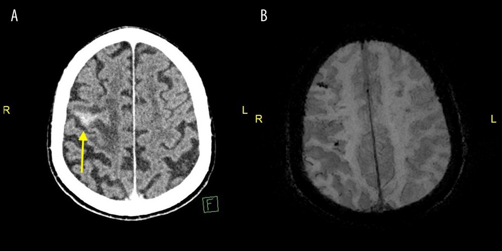 Axial view of CT head (A) showing hyperdensity (yellow arrow) and SWI-MRI (B) of the corresponding section not showing any signal drop-out in areas corresponding to the hyperdensity.