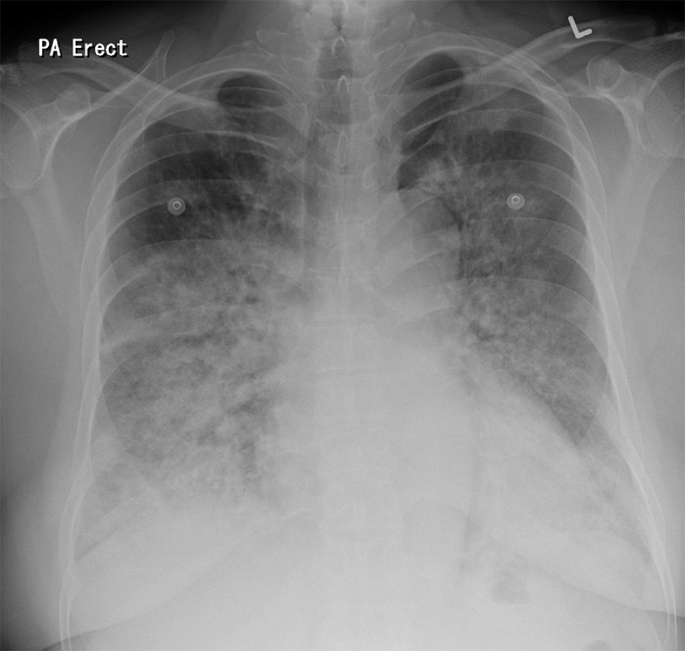 Chest radiography on admission. Diffuse airspace opacities are noted.