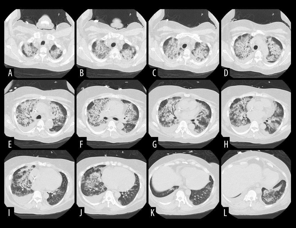(A–L) Computed tomography of the chest that shows bilateral pulmonary infiltrates, most notable in the mid- to upper lung fields without evidence of acute pulmonary embolism.