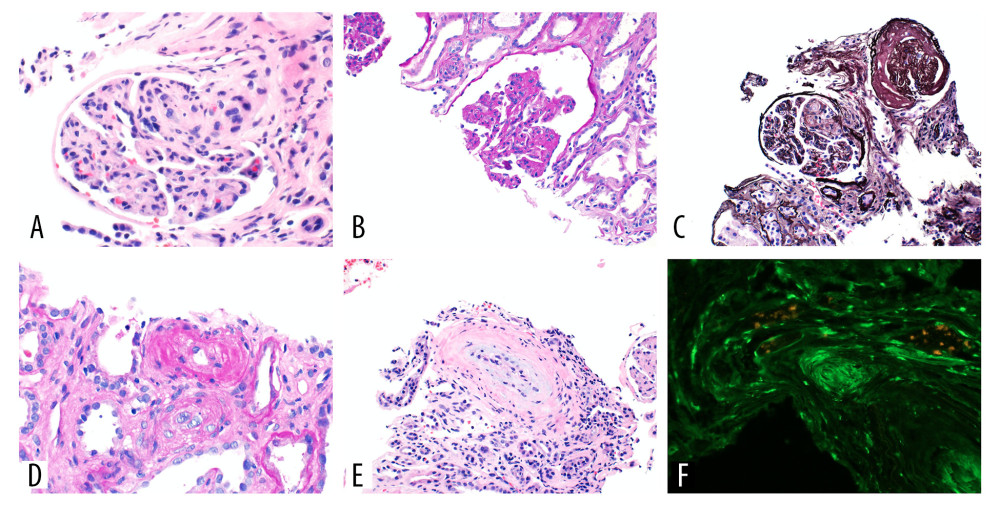 Kidney biopsy findings. (A, B) Glomeruli with ischemic changes and mesangiolysis. (C) Silver stain finding. (D) Arteriolar hyalinolysis. (E) Mucointimal edema. (F) Immunofluorescent staining for fibrinogen.