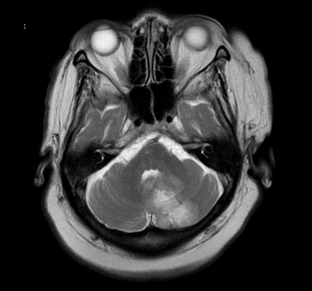 Magnetic resonance imaging of the brain (T2 Propeller image) showing abnormal signal in the left posterior inferior medial cerebellum. The area measures 4×2.6×2.7 cm and is producing a mass effect in the fourth ventricle.