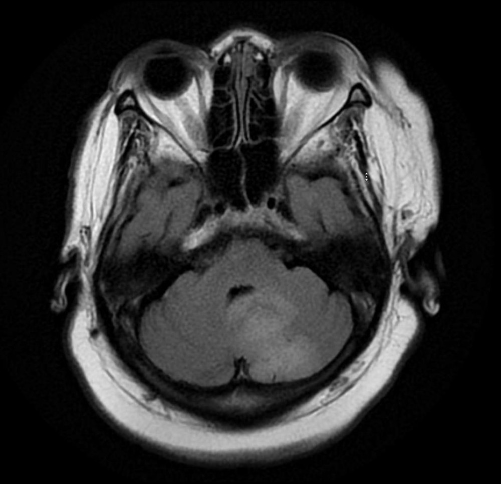 Magnetic resonance imaging of the brain (T2 flair image) showing abnormal signal in the left posterior inferior medial cerebellum, which showed bright signal intensity on T2 and flair.