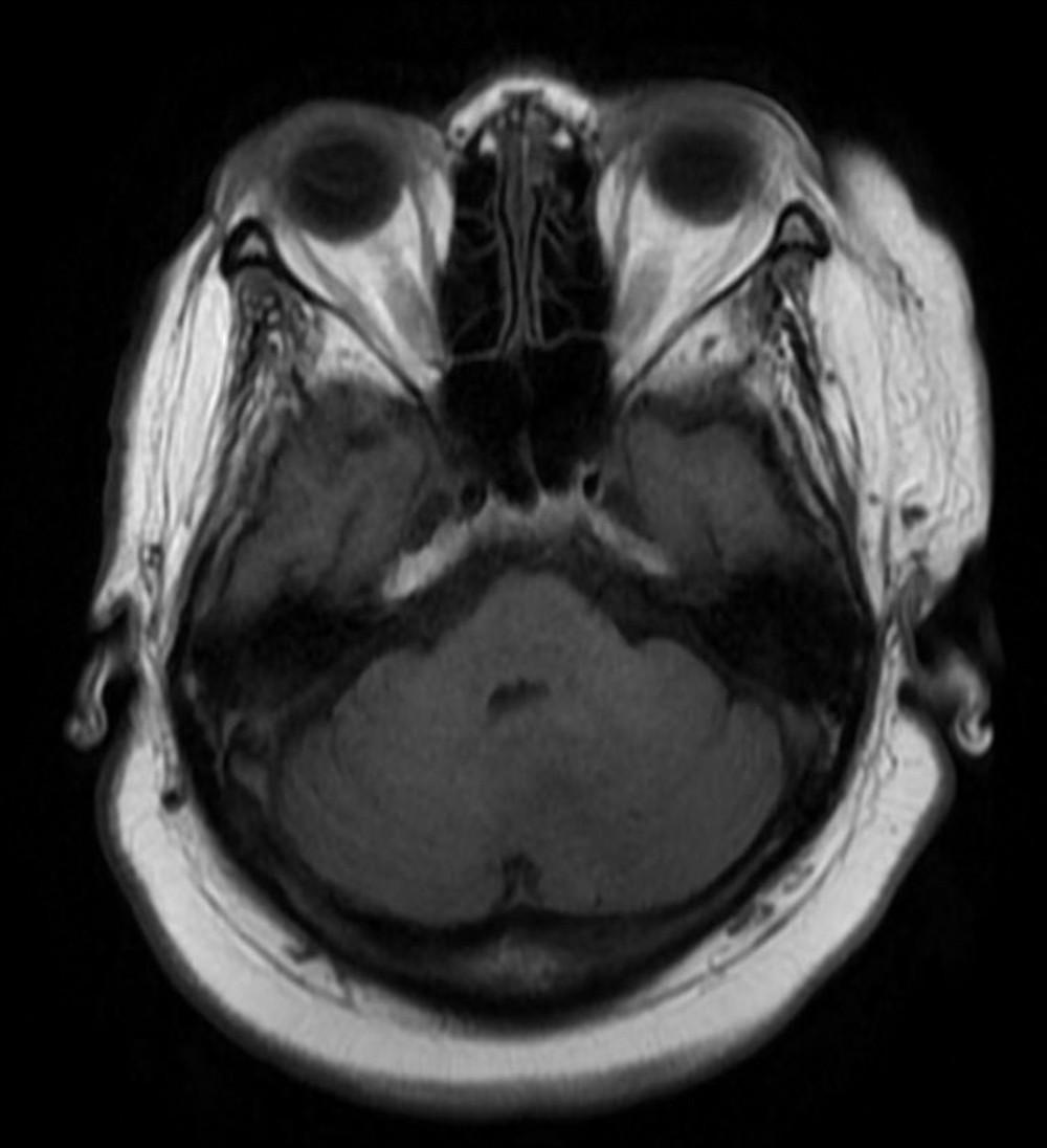 Magnetic resonance imaging of the brain (T1 Axial image) showing low signal intensity on T1.