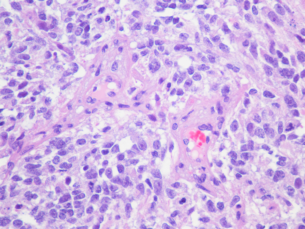 Histopathologic findings from left cerebellar biopsy (hematoxylin and eosin staining), showing infiltrating glial neoplasm with highly atypical and pleomorphic tumor cells containing irregular hyperchromatic nuclei and distinct nucleoli.