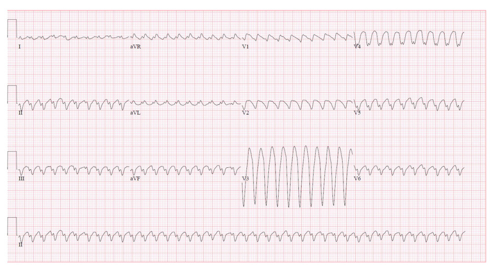 Electrocardiogram showing a monomorphic ventricular tachycardia in a 71-year-old man admitted with sudden onset of shortness of breath, profuse diaphoresis, lightheadedness, and presyncope symptoms.