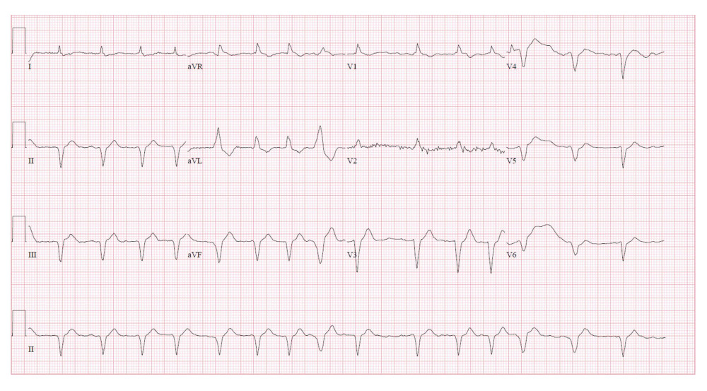 Electrocardiogram showing atrial fibrillation after electrical cardioversion due to unresponsive medical treatment for ventricular tachycardia and voltage discrepancy and pseudo-infarct pattern in a 71-year-old man.