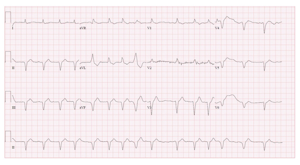 Electrocardiogram showing atrial fibrillation after electrical cardioversion due to unresponsive medical treatment for ventricular tachycardia and voltage discrepancy and pseudo-infarct pattern in a 71-year-old man.