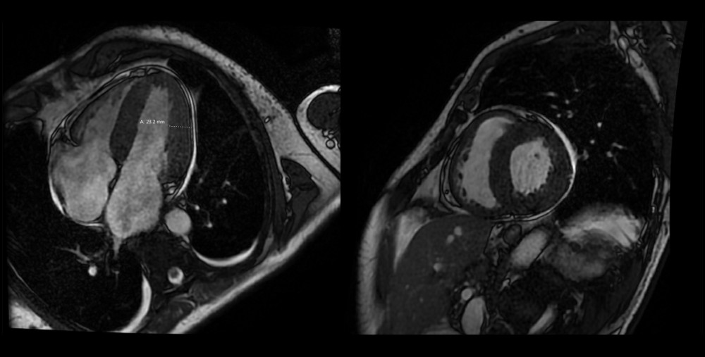 Cardiac magnetic resonance imaging showing a global left ventricular hypertrophic cardiomyopathy with notable diffuse patchy enhancement of the entire left ventricle with thickening of the interatrial septum.