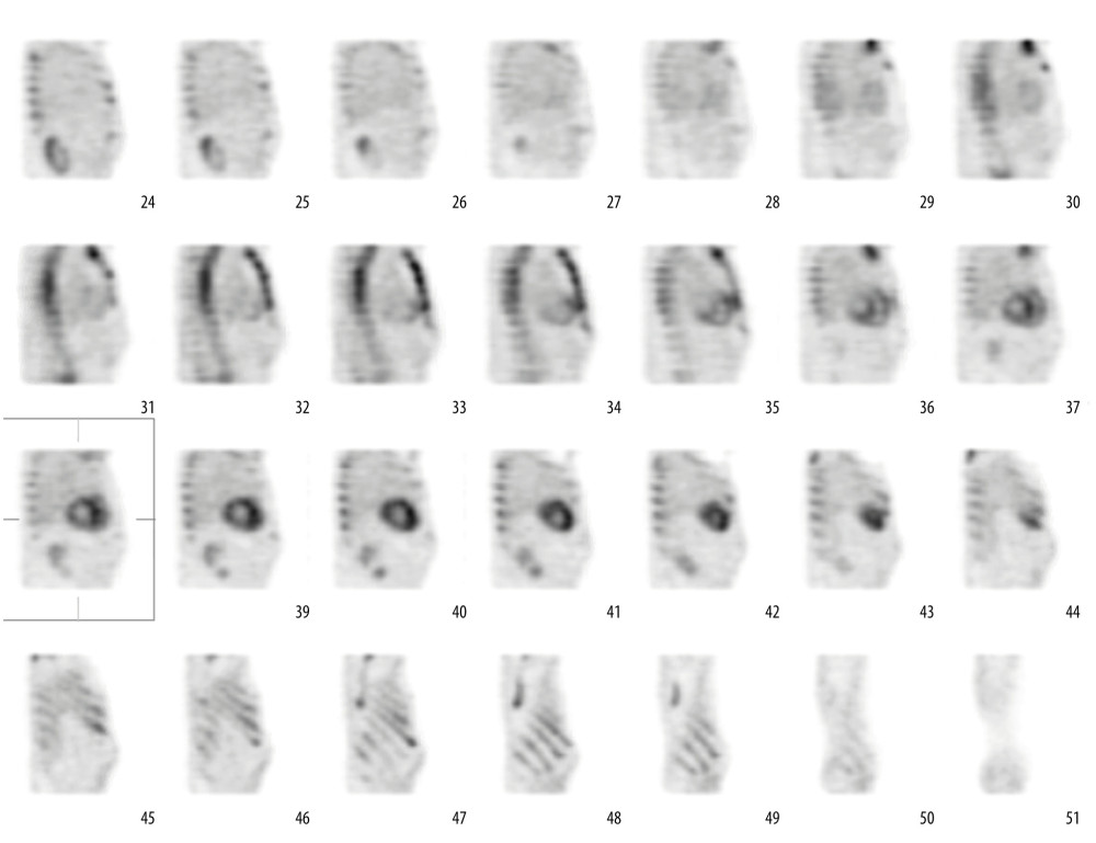 A 99m technetium pyrophosphate single-photon emission computerized tomography scan showing a grade 3 visual uptake and a heart-to-contralateral lung ratio of 1.92.