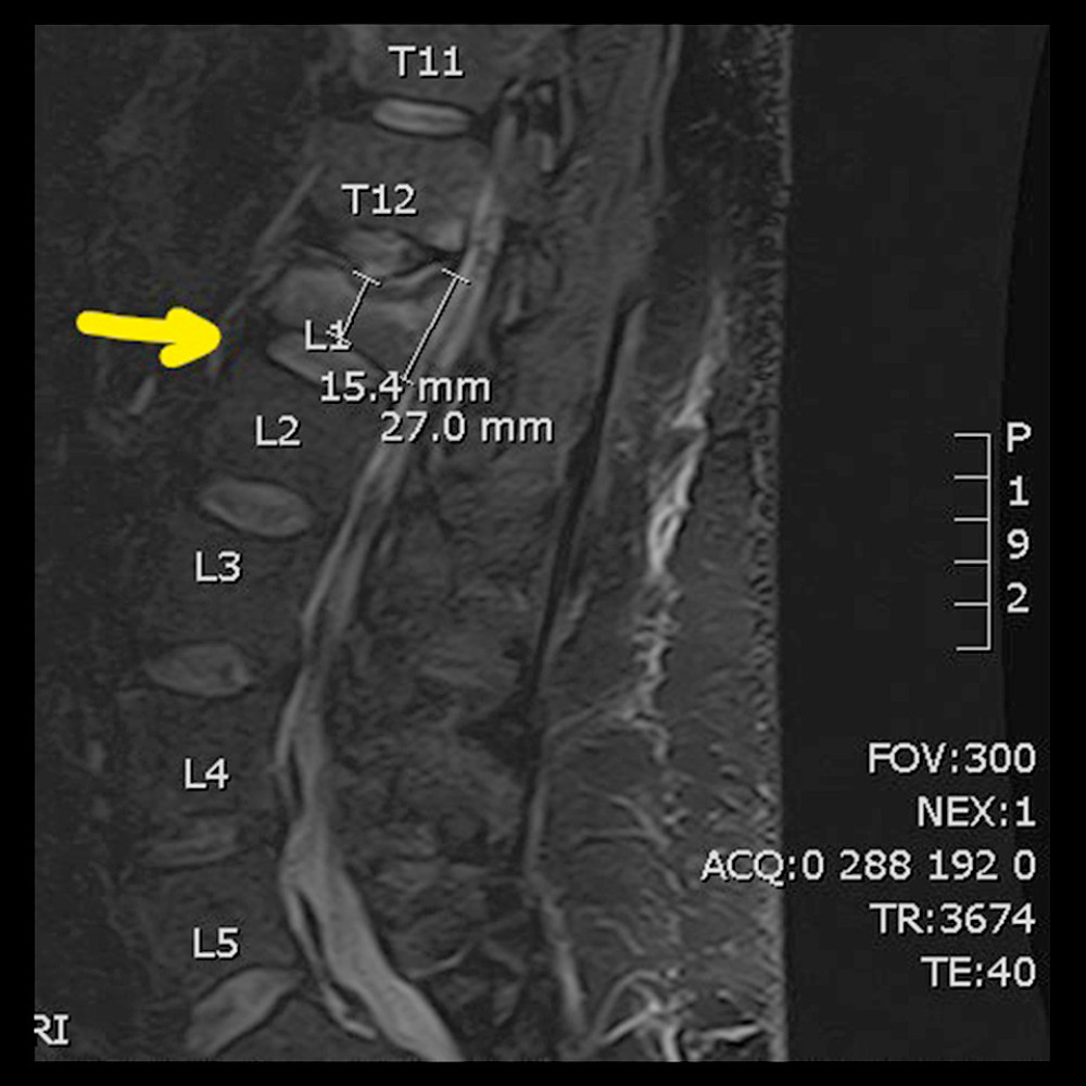 Magnetic resonance imaging scan illustrating the patient’s lumbar compression fracture.