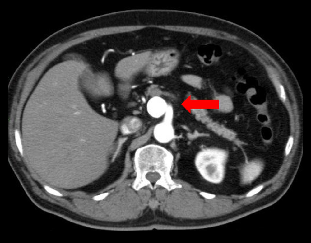 A contrast-enhanced abdominal computed tomography scan shows a 3.9-cm visceral artery aneurysm (arrow).