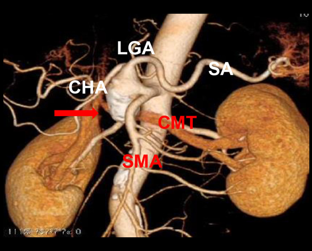 A 3-dimensional volume-rendered computed tomography scan shows the celiacomesenteric trunk (CMT). The CMT divides into the celiac artery (CA) and superior mesenteric artery. The common hepatic artery, splenic artery, and left gastric artery are seen arising from the CA. The visceral artery aneurysm (arrow) originated from the CA. CHA – common hepatic artery; LGA – left gastric artery; SA – splenic artery; SMA – superior mesenteric artery.