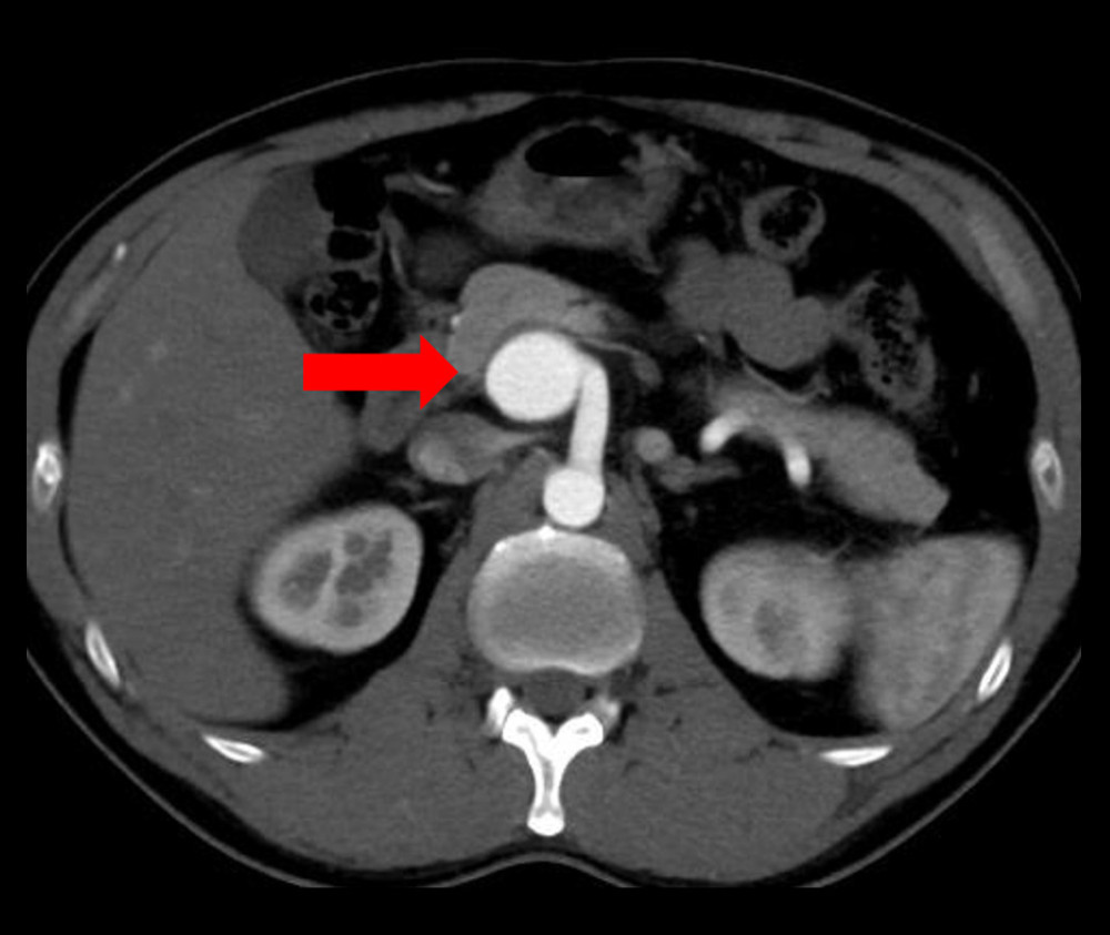 A contrast-enhanced abdominal computed tomography scan shows a 3.0-cm visceral artery aneurysm (arrow).