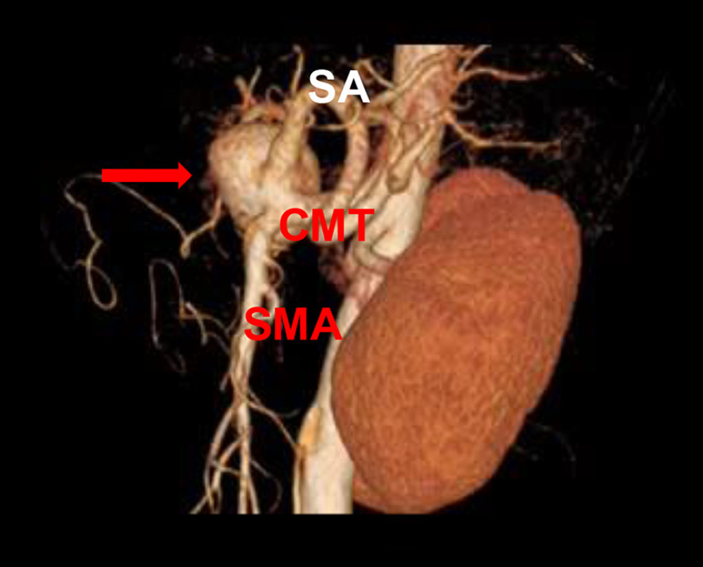 A 3-dimensional volume-rendered computed tomography scan shows the celiacomesenteric trunk (CMT). The CMT divides into the celiac artery (CA) and superior mesenteric artery. The common hepatic artery and splenic artery are seen arising from the CA. The visceral artery aneurysm (arrow) originates from the CA. SA – splenic artery; SMA – superior mesenteric artery.