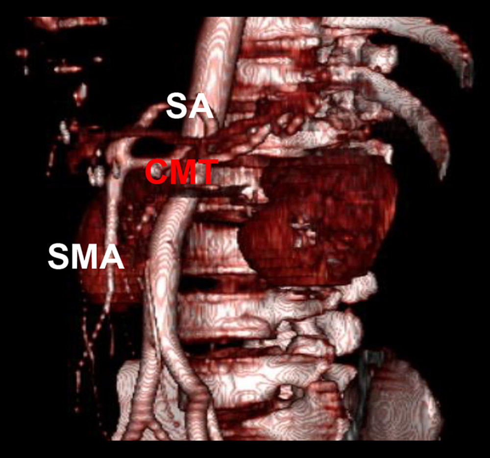 A postoperative 3-dimensional computed tomography scan shows the saphenous vein graft that was used as a patch for the roof reconstruction and that the aneurysm has been removed. CMT – celiacomesenteric artery; SA – splenic artery; SMA – superior mesenteric artery.