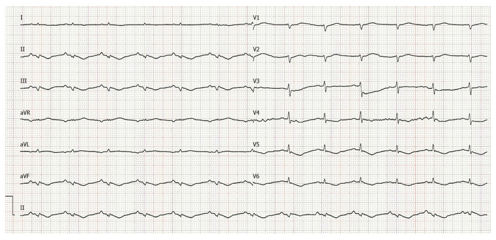Electrocardiogram of the patient at the time of admission to the clinic.
