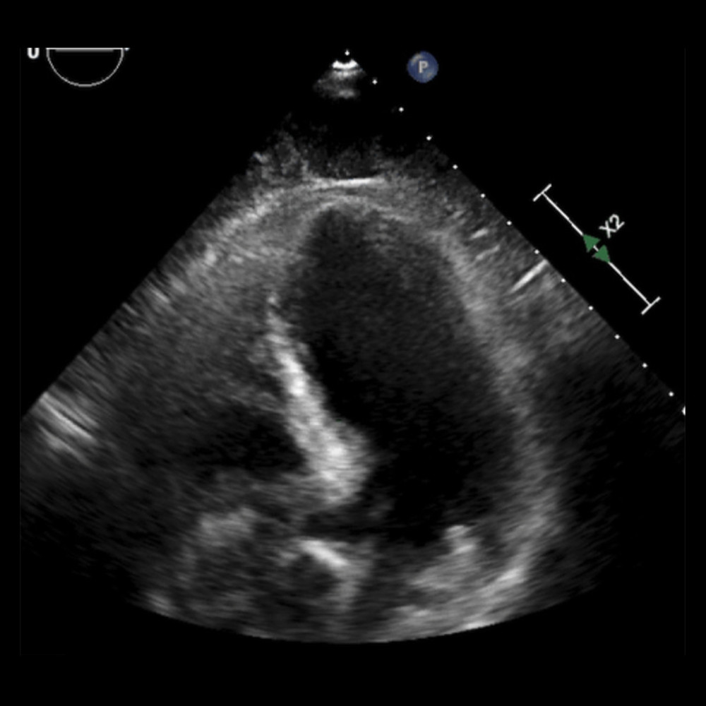 Echocardiography, left ventricle in diastole; takotsubo image.